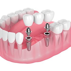 Exploded illustration of implant bridge